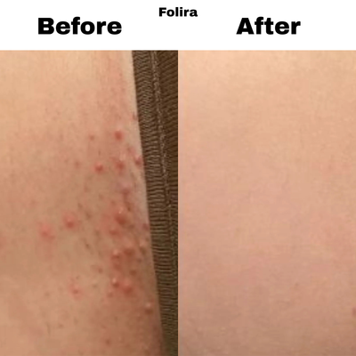 Folira Hydrocolloid DermRoll