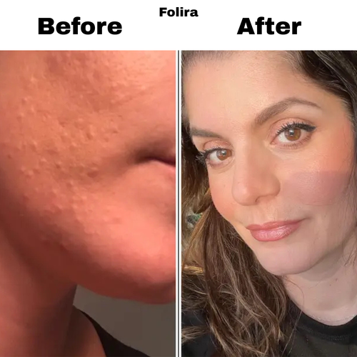 Folira Hydrocolloid DermRoll
