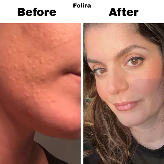 Folira Hydrocolloid DermRoll