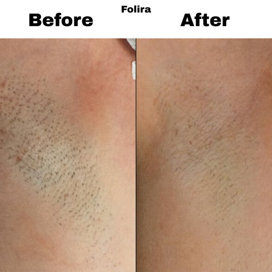 Folira Hydrocolloid DermRoll