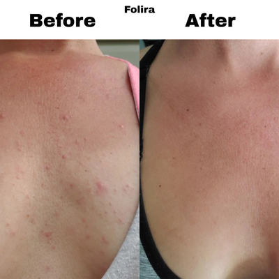 Folira Hydrocolloid DermRoll