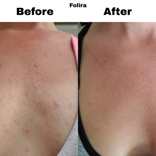 Folira Hydrocolloid DermRoll